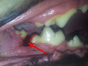 tooth gap