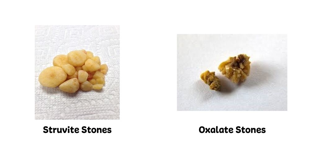 Oxalate and Struvite stones